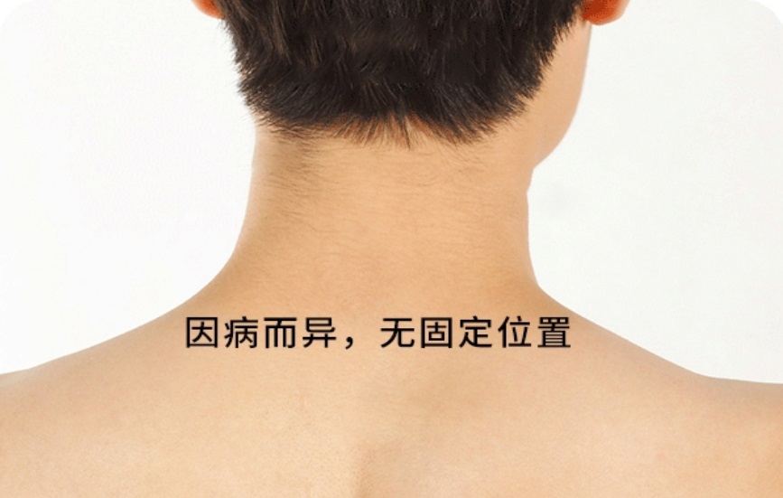 阿是穴